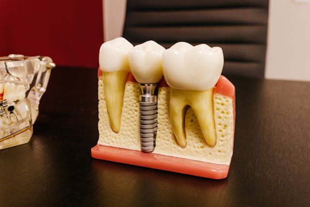 A Step-By-Step Look At The Dental Implant Journey (From Start To Finish)